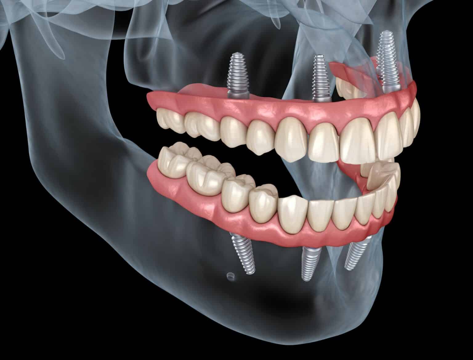 What Are All-On-4 Dental Implants? An Essential Guide - MOM News Daily